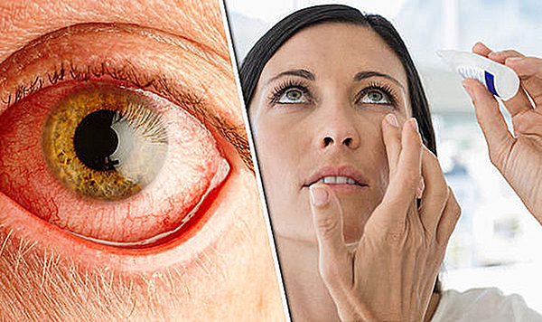 Đỏ mắt có thể là triệu chứng ban đầu của một số căn bệnh nghiêm trọng. Ảnh: Daily Express