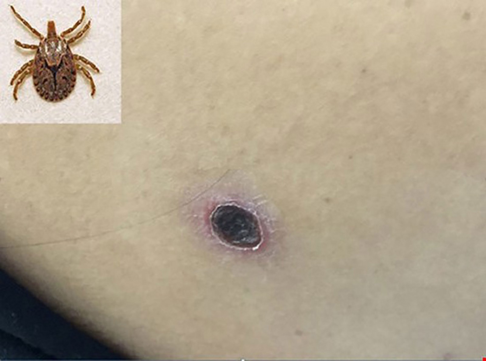 Ảnh con mò (trên) và vết loét đặc trưng của bệnh sốt mò. Ảnh: Minh họa (internet)