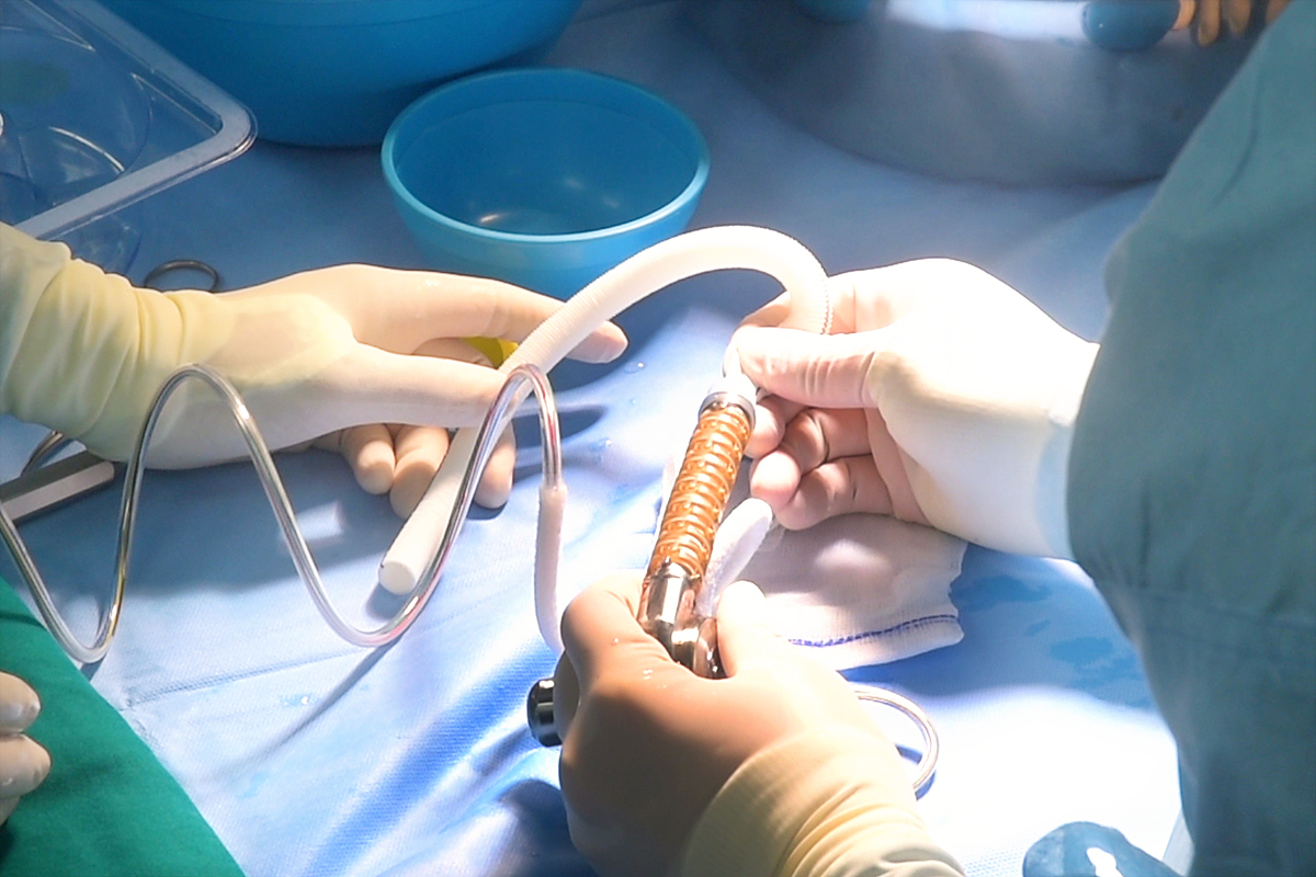 Vinmec cấy ghép thành công tim nhân tạo hổ trợ tâm thất cho bệnh nhân suy tim giai đoạn cuối