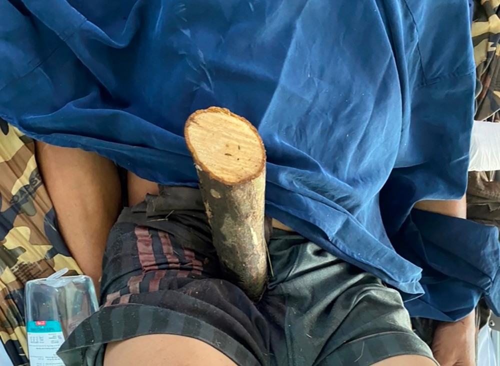 Bệnh nhân bị cọc bần xuyên hạ vị. Ảnh: BV cung cấp