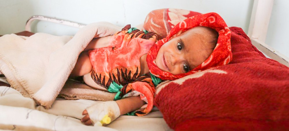Một em bé Afghanistan bị suy dinh dưỡng nặng. Ảnh: UNICEF