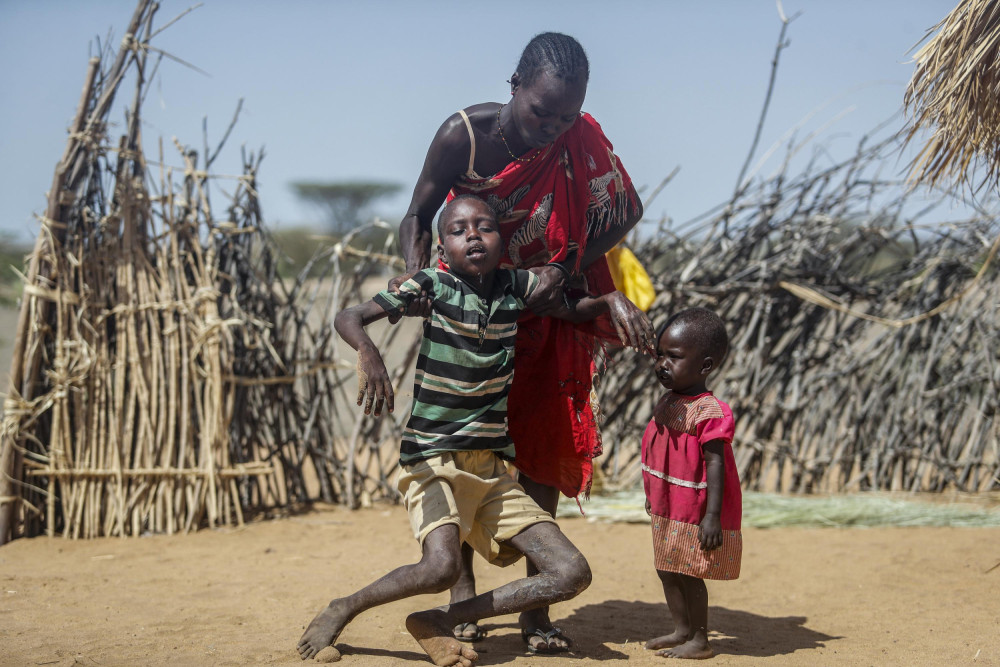 Một đứa trẻ Kenya bị suy dinh dưỡng yếu đến mức không thể tự đứng lên. Ảnh: AP