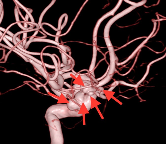 Các vị trí túi phình mạch máu não của bà T trên hình ảnh DSA. Ảnh BV cung cấp
