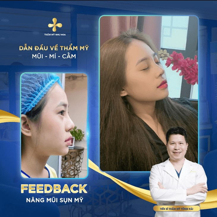 Nâng mũi sụn Mỹ có tốt không? Chi phí nâng mũi bao nhiêu