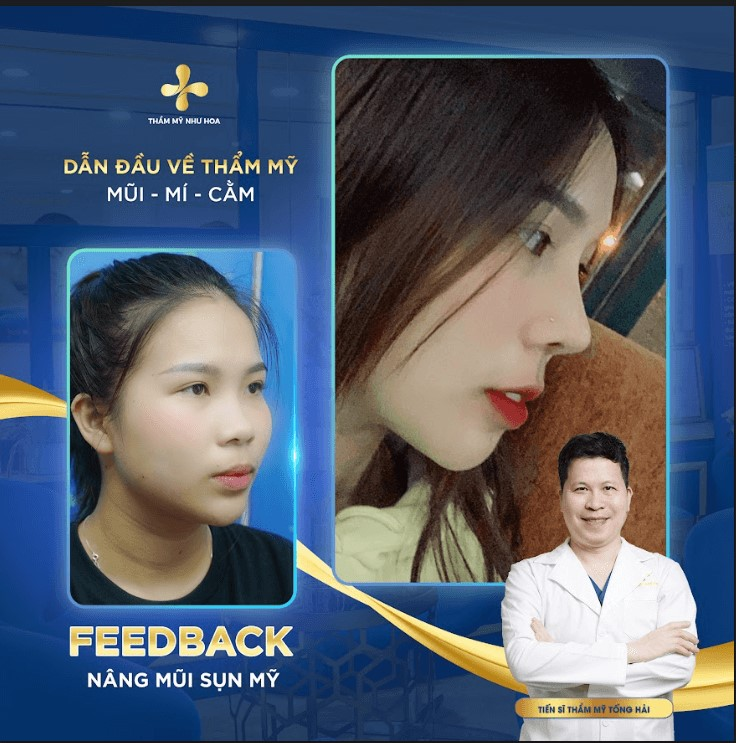 Nâng mũi sụn Mỹ có tốt không? Chi phí nâng mũi bao nhiêu