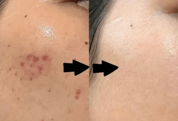 Tầm quan trọng của việc khám da liễu và tiêm meso trị nám đúng thời điểm