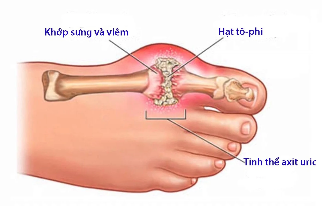 Điều trị bệnh gout theo Y học cổ truyền