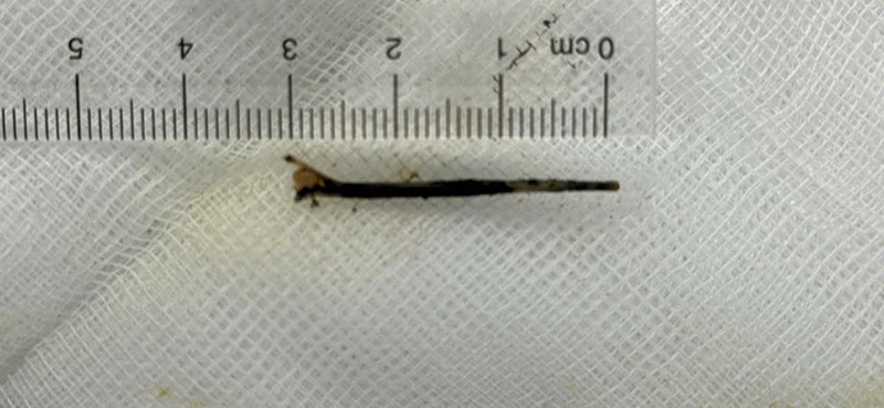 Hy hữu xương cá 3cm xuyên vào đường mật