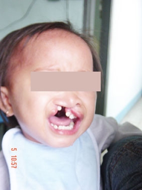 Sức khỏe của bà mẹ mang thai có liên quan đến dị tật sứt môi - hở hàm ếch