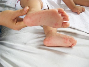 Làm gì để phòng bệnh tay chân miệng ?