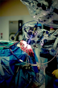 Lần đầu tiên, robot bóc tách khối u não