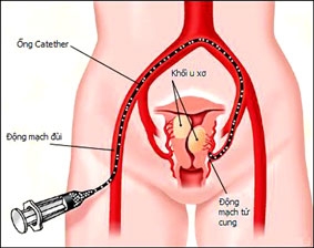 Phát hiện sớm u xơ tử cung