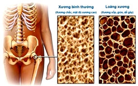 Loãng xương - bệnh lý thầm lặng nhưng nguy hiểm