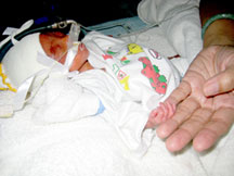 Gia tăng số trẻ sinh non