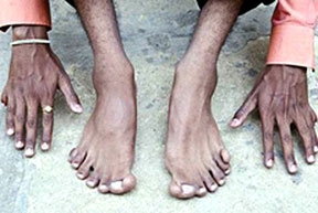 Người có 12 ngón tay, 14 ngón chân