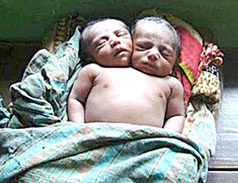 Em bé 2 đầu qua đời