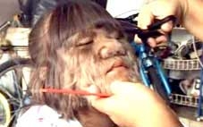 Tìm được cách chữa cho “cậu bé người sói”?