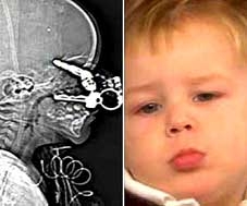 Không hề hấn sau khi bị chìa khóa ghim vào não