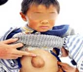 Tim ngoài cơ thể