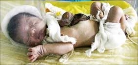 Thêm một trường hợp tim nằm ngoài da