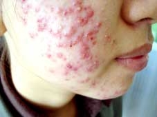 Mụn trứng cá- Không nguy hiểm nhưng vẫn đáng lo