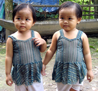 Hai bé song sinh bị bệnh lách to cần được giúp đỡ