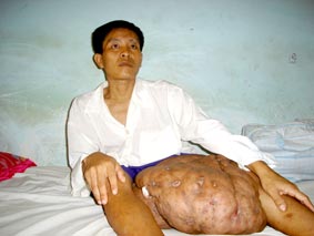 Anh Tưởng với căn bệnh hiểm nghèo