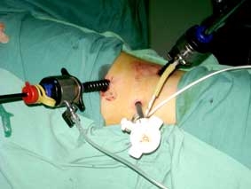 Phẫu thuật nội soi cho hai bệnh nhân bị dị tật niệu quản