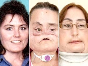 Bệnh nhân ghép mặt đầu tiên ở Mỹ lộ diện