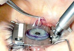Mỹ: Quảng cáo mổ Lasik phải 
cảnh báo nguy cơ