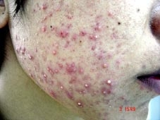 Làm đẹp - <br>
cẩn thận với dị ứng mỹ phẩm