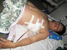 Phẫu thuật lấy đầu đạn nằm trong phổi bệnh nhân suốt 35 năm