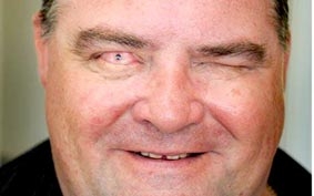 Sáng mắt nhờ ghép răng vào mắt