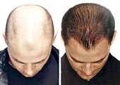 Có thể đoán biết khi nào đầu hói
