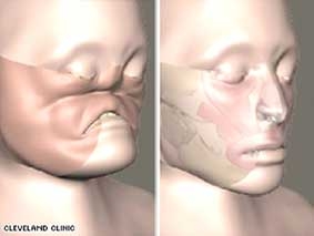 Tây Ban Nha 
ghép toàn mặt thành công