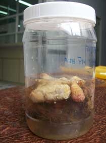 Phẫu thuật lấy khối thai dị dạng 
trong lồng ngực bệnh nhân