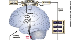 Biến suy nghĩ của bệnh nhân 
liệt toàn thân thành lời nói