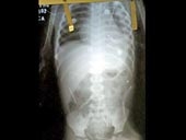 50 kim khâu 
trong người em bé 2 tuổi