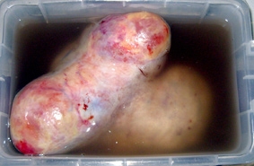 Phẫu thuật lấy khối u nang nặng 4 kg