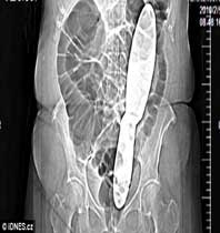 Để quên dụng cụ phẫu thuật trong bụng