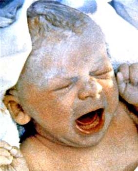 Hầu hết trẻ thụ tinh ống nghiệm đều khỏe mạnh