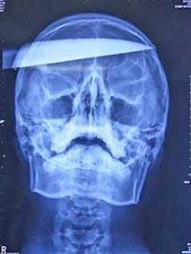 Bị chém xuyên đầu vẫn sống!