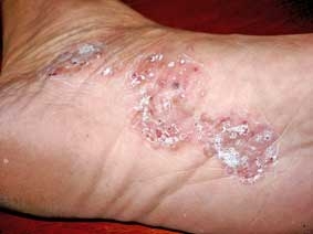 Bệnh tổ đỉa dễ tái phát