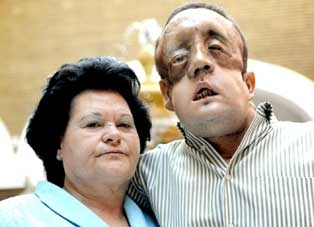 Bệnh nhân ghép mặt thứ 2 
ở Tây Ban Nha xuất viện