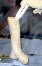 Tế bào gốc cứu sống bệnh nhân ung thư ở châu Âu