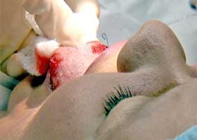 Dùng miếng dán lưỡi có thể giảm cân?