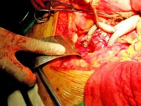 Ghép động mạch chủ bụng nhân tạo cho bệnh nhân 

cao tuổi bị cao huyết áp