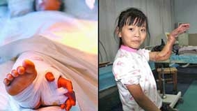 Ghép tay vào chân