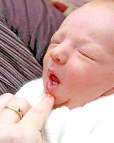 Mọc răng từ lúc mới sinh