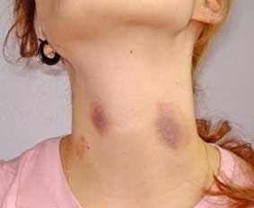 Bị liệt vì vết “cắn yêu”!